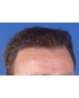 After Hair Transplant&nbsp;Front